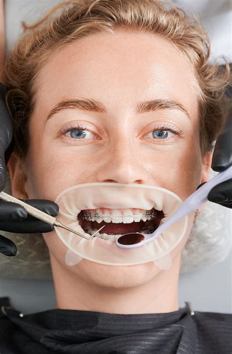 Dental Insurance that Covers Orthodontics: The Ultimate Guide