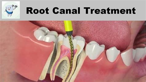 Dentistry Explained Patient Guide to Root Canal Therapy Doc