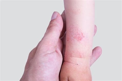 Dermatite: Contagiosa ou Não?