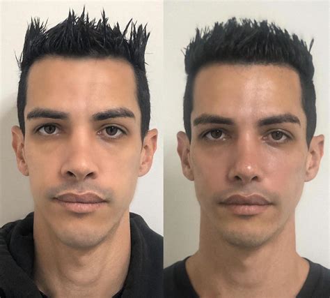 Descobrindo o Custo da Harmonização Facial Masculina: Investindo em Sua Aparência Confiante