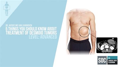 Desmoid Tumors Kindle Editon