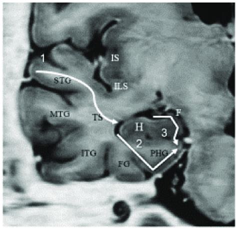 Devilectomy: