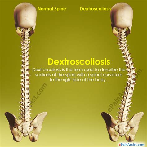 Dextrocurvature of Lumbar Spine: A 101 Guide