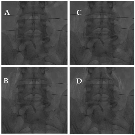 Dextrocurvature of the Lumbar Spine: A Comprehensive Guide to Diagnosis, Treatment, and Prevention