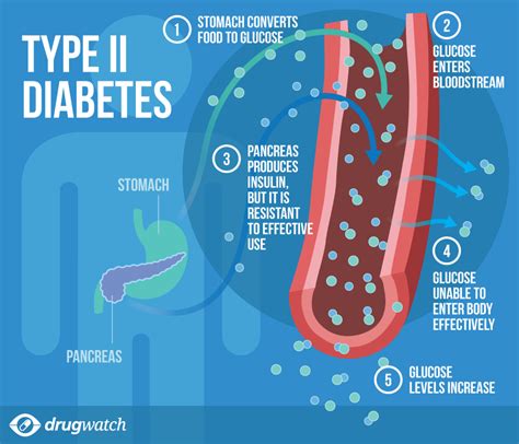 Diabetes Type 2 and What to Do Kindle Editon