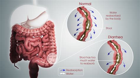 Diarrhea: