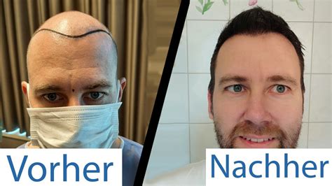 Die Zukunft der Haartransformation