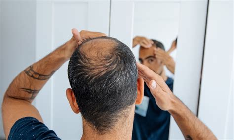 Die ultimative Lösung für männlichen Haarausfall: Dauerhafte Haarfixierung für Männer