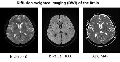 Diffusion-Weighted MR Imaging Applications in the Body Kindle Editon