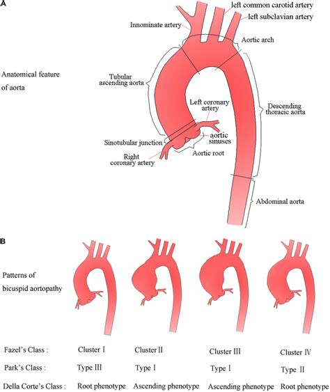 Dilated Ascending Aorta (DAA): An Overview