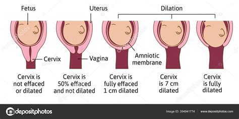 Dilated Cervix Chart