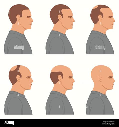 Discover the 101 Guide to Ending Hair Loss on Top of Head