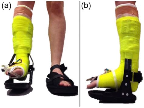 Discover the Patella Tendon Bearing Cast: A Comprehensive Guide