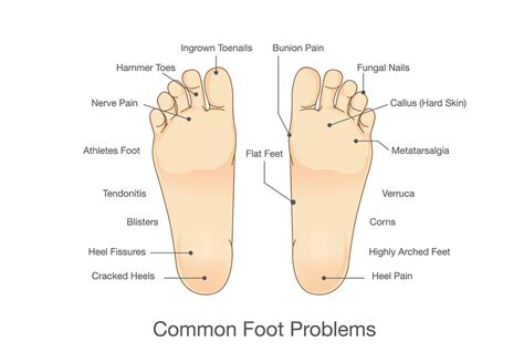 Doar a Soles for Different Foot Problems