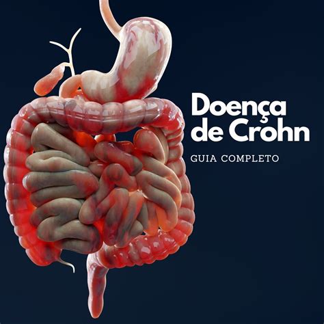 Doença de Crohn: Um Guia Completo para Entender e Tratar a Condição