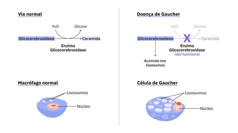 Doença de Gaucher