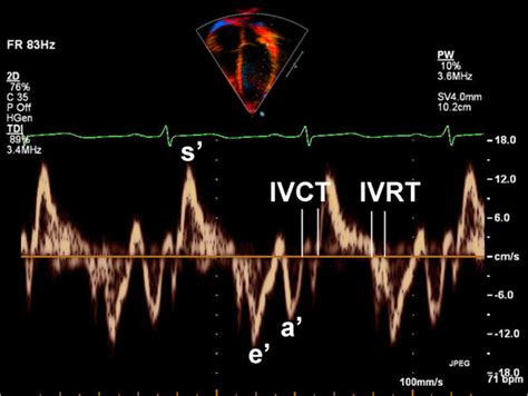 Doppler Tissue Imaging Echocardiography PDF