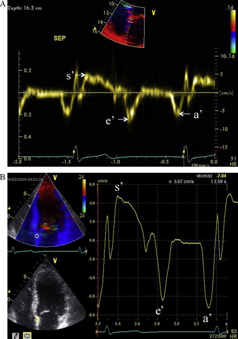 Doppler Tissue Imaging Echocardiography PDF