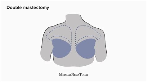 Double incision mastectomy: