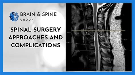 Dr. Stanley's Approach to Spine Surgery