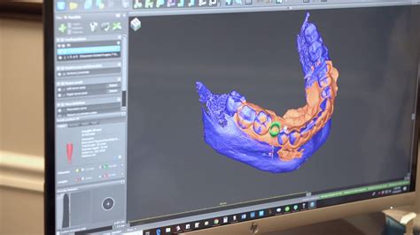 Drills3D Studio: Empowering Precision and Productivity in Dental Implant Planning