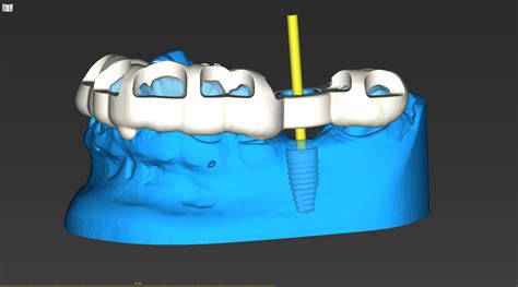 Drills3D Studio: The Comprehensive Guide to Dental Implant Planning and Surgery