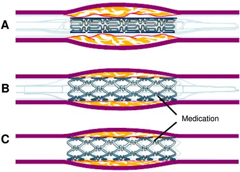 Drug Eluting Stents Drug Eluting Stents Existing Era and New Concerns PDF