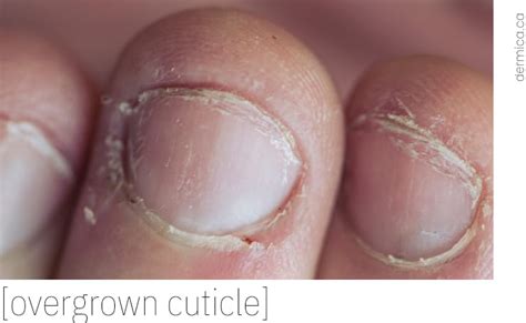 Dry Cuticles: Causes, Treatments, and Prevention