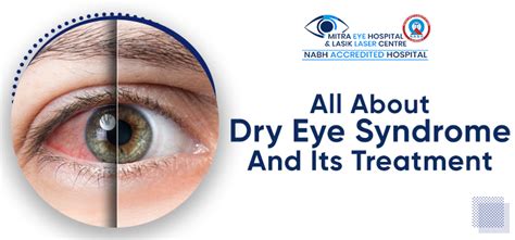 Dry Eye Syndrome: