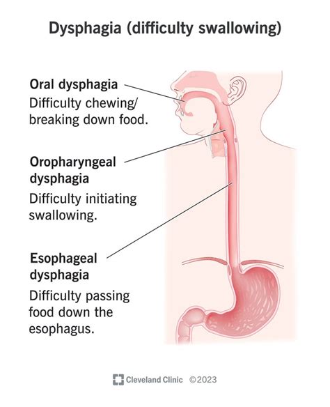 Dysphagia: A Growing Concern