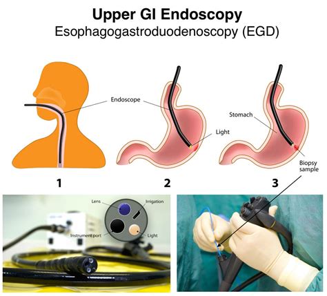 EGD with Esophageal Acid Suppression: