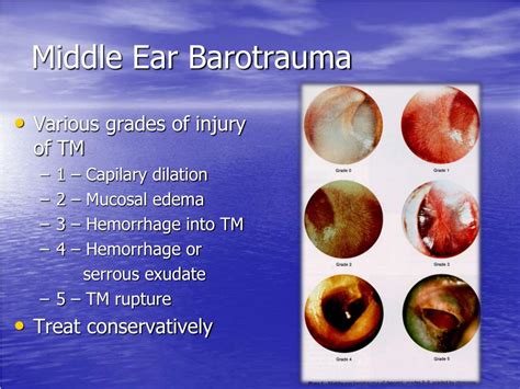 Ear Barotrauma: