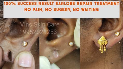 Earlobe Reconstruction: 100% Success Rate