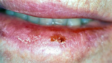 Early Lip Cancer Photos: A Guide to Symptoms, Diagnosis, and Treatment