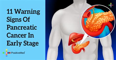 Early Stage Pancreatic Cancer