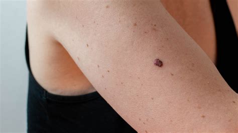 Early Stage Pictures of Cancerous Moles: A Visual Guide to Spotting Skin Cancer Early