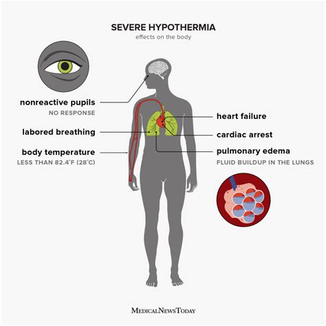 Effects of Hypothermia: