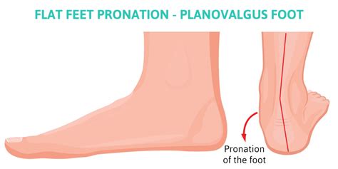 Effects of Overpronation