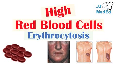 Elevated RBC in Blood: A Comprehensive Guide to Erythrocytosis