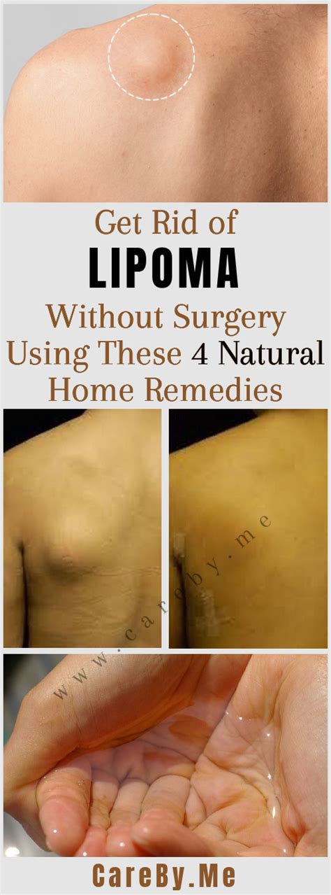 Eliminate Lipomas Naturally: Discover the Power of Homeopathic Remedies for Lipoma Relief