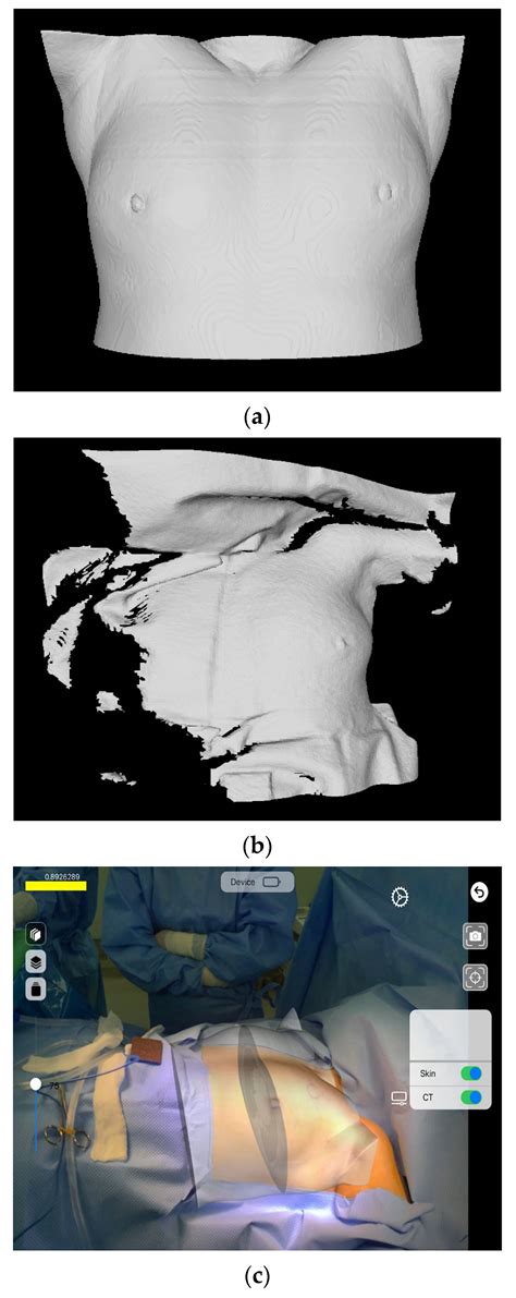 Elle Breast Surgery Augmented: Explore Options & Make an Informed Decision