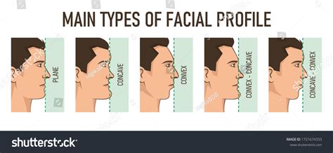 Elongates the facial profile: