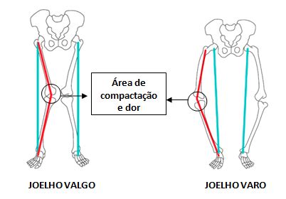 Encontre equilíbrio e estabilidade: Compreendendo os joelhos valgo e varo