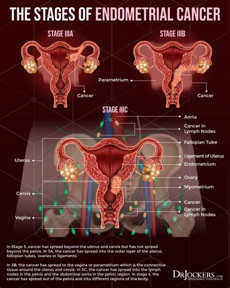 Endometrial Adenocarcinoma ICD-10: Uncover the Diagnosis and Treatment Insights