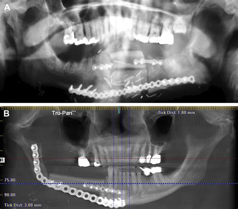 Endosseous Implants for Maxillofacial Reconstruction Epub