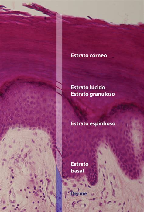 Epidermal veenacos