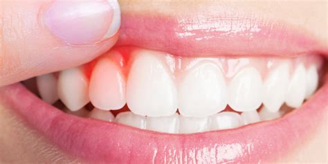 Eradicating White Spots on Gums: A Comprehensive Guide to Optimal Oral Health