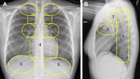 Errors in Chest Radiography Kindle Editon