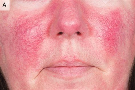 Erythematotelangiectatic rosacea (ETR)