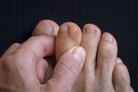 Everything You Need to Know About Blisters on Pinky Toes: Causes, Treatments, and Prevention